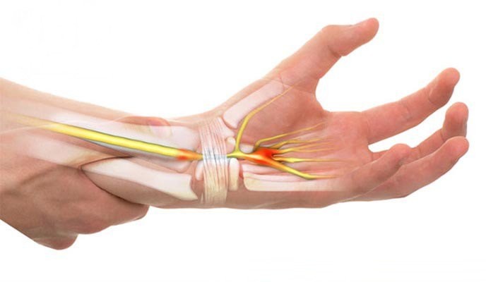 Bài thuốc hay dành cho người bị đau khớp cổ tay trái