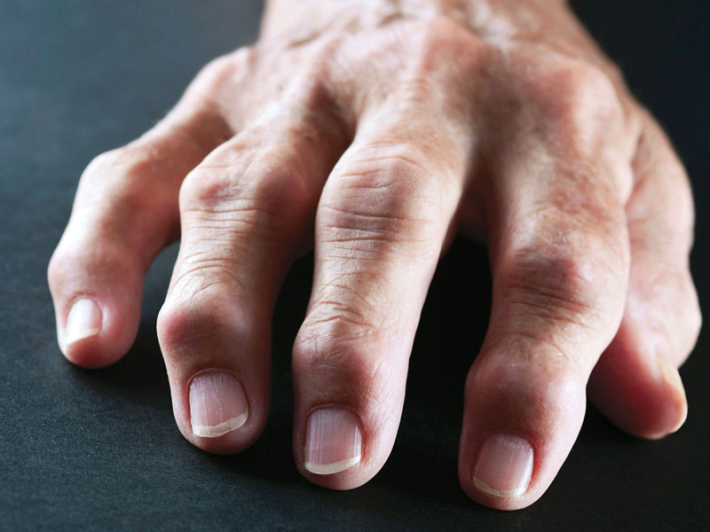 Mỏi chân tay do phong tê thấp là một tình trạng bệnh mãn tính